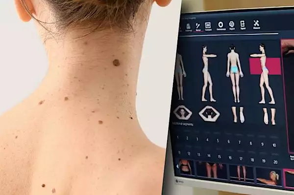 Μάθε τι πρέπει να κάνεις εάν έχεις σπίλους Μάθε τι πρέπει να κάνεις εάν έχεις σπίλους