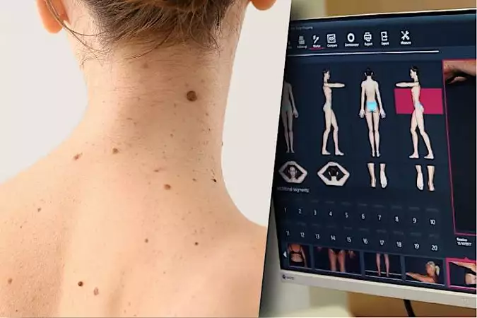 Μάθε τι πρέπει να κάνεις εάν έχεις σπίλους