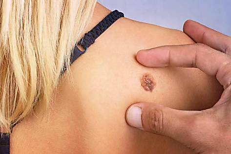 Dermatitis - Common Signs & Symptoms (Take a Look)