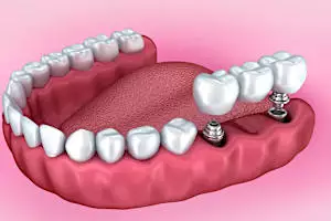 למדו על השתלת שיניים ביום אחד לקשישים בישראל