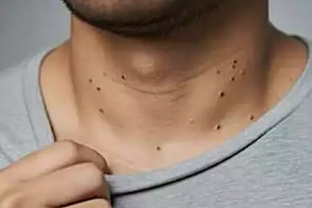 Αν έχετε κονδυλώματα στο λαιμό ή στις μασχάλες, διαβάστε αυτό!