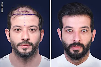 Μεταμόσχευση μαλλιών με επαναστατική τεχνολογία και εκπληκτικά αποτελέσματα