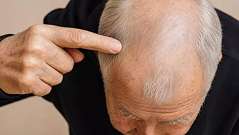 Men’s Hair Will Grow Back in 2 Weeks! Do This First! Men’s Hair Will Grow Back in 2 Weeks! Do This First!