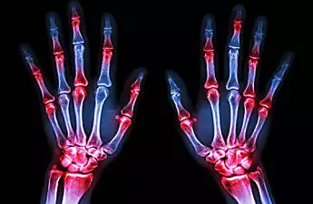 8 Signs You May Have Rheumatoid Arthritis. Research Rheumatoid Arthritis Pain Medications