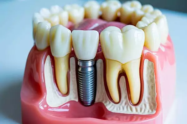 Τι καλύπτει ο ΕΟΠΥΥ για εμφυτεύματα δοντιών στην Ελλάδα το 2025