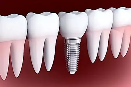 Here's What New Dental Implants Should Cost in Bengaluru