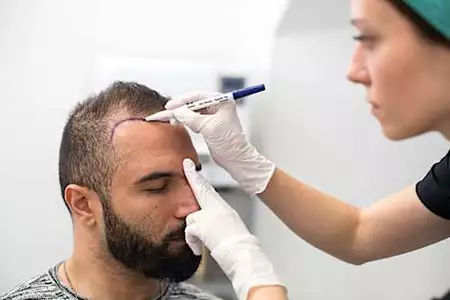 Quanto custará um transplante capilar completo em 2021?