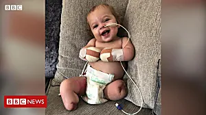 Baby loses all four limbs to sepsis