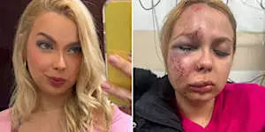 Jovem agredida no Metrô de SP teve joelho, maxilar e nariz quebrados: ‘Ele queria que eu morresse’ Jovem agredida no Metrô de SP teve joelho, maxilar e nariz quebrados: ‘Ele queria que eu morresse’