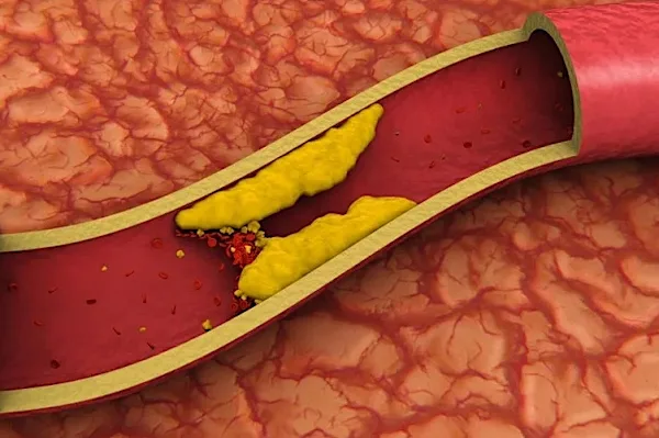 [Pics] Foods That Will Help Unclog Arteries