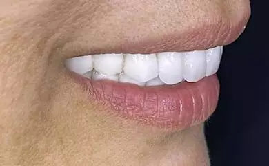 Full Mouth Dental Implant Cost