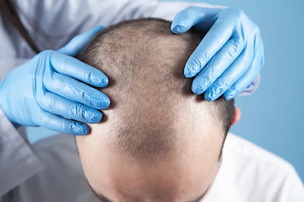 Indonesia: Cost Of Hair Transplant Might Surprise You