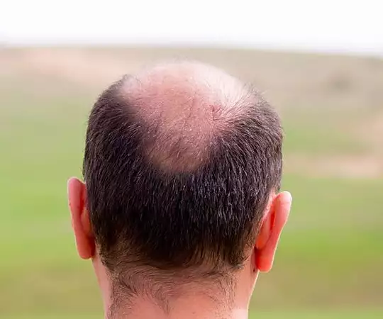 Hair Transplant Cost in Turkey Might Surprise You