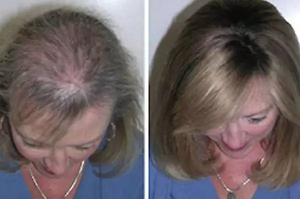 Το εκπληκτικό οικιακό αντικείμενο που χρησιμοποιούν οι άνθρωποι για την αναγέννηση των μαλλιών Το εκπληκτικό οικιακό αντικείμενο που χρησιμοποιούν οι άνθρωποι για την αναγέννηση των μαλλιών