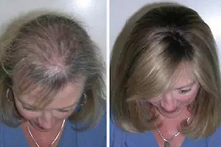 The Surprising Household Item People Are Using for Hair Regrowth