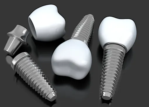 Dental implants in Turkey: See options