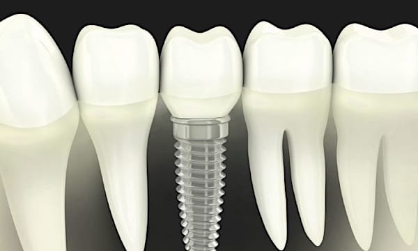 Here's What Dental Implants Could Cost in 2020 Here's What Dental Implants Could Cost in 2020