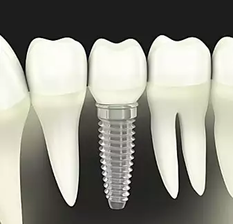 Here's What New Dental Implants Should Cost in 2020