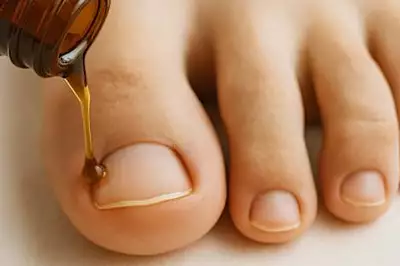 Você sofre de micose nas unhas? Experimente este truque simples hoje à noite (é genial!). Você sofre de micose nas unhas? Experimente este truque simples hoje à noite (é genial!).