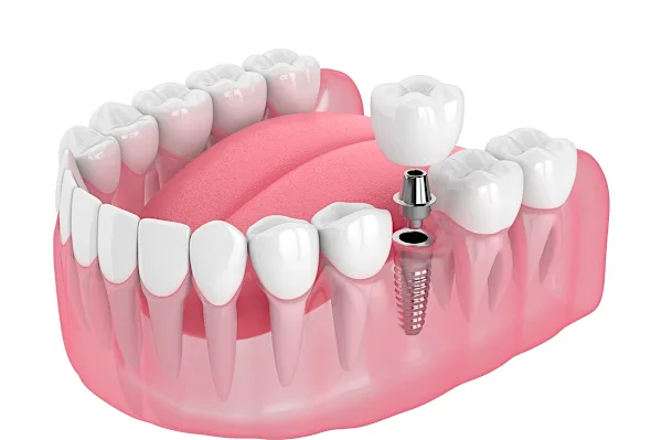 Dental Implants Cost for Seniors in Benin City might surprise you