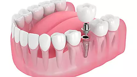 ¡Implantes dentales de boca completa en Turquía! El costo puede sorprenderte