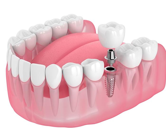 ¡Implantes dentales de boca completa en Turquía! Los precios pueden sorprenderte