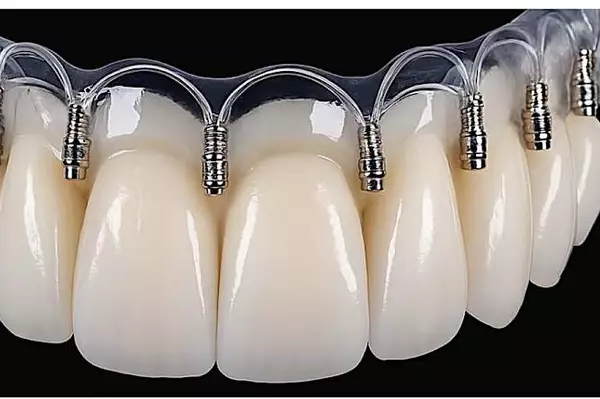 Οδοντικά εμφυτεύματα χωρίς βίδες: τι είναι και πώς λειτουργούν Οδοντικά εμφυτεύματα χωρίς βίδες: τι είναι και πώς λειτουργούν