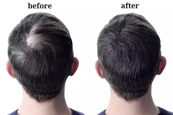 Nigeria: See The New Hair Loss Treatments Everyone Is Using 2024