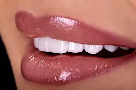 2023年的植牙費用可能使您驚訝 2023年的植牙費用可能使您驚訝