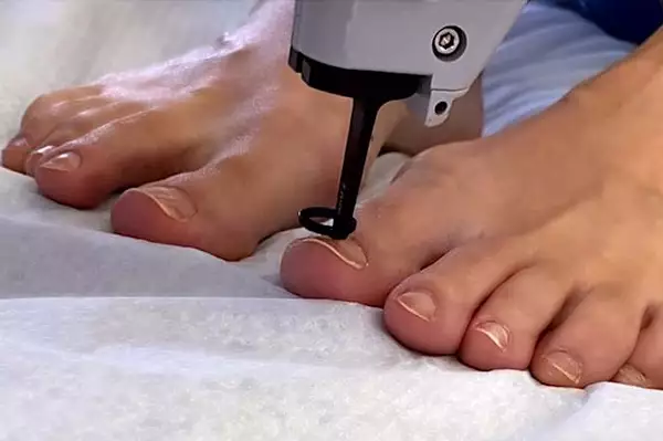 Μάθε πώς αντιμετωπίζεις τους μύκητες στα νύχια Μάθε πώς αντιμετωπίζεις τους μύκητες στα νύχια