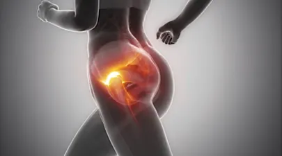 Sciatica Is Not from a Slipped Disc. Meet the Real Enemy of Sciatica (Stop Doing This)