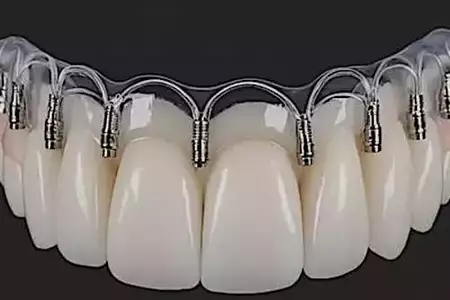 Che cosa sono gli impianti dentali senza viti e quanto costano a Rabat?