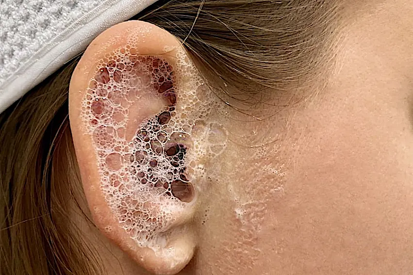 What Causes Tinnitus And What Helps To Stop It Will Surprise You (stop doing this)