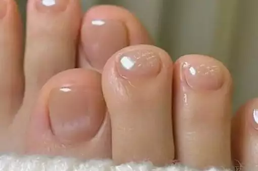 Νέα συζήτηση στο φαρμακείο για αυτό το κόλπο για τον μύκητα των νυχιών (λειτουργεί σαν πλυστικό μηχάνημα υψηλής πίεσης)