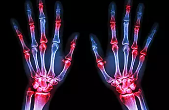 8 Signs You May Have Rheumatoid Arthritis. Research Severe Rheumatoid Arthritis Treatment