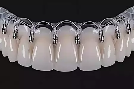 Che cosa sono gli impianti dentali senza viti e quanto costano a Rabat? Che cosa sono gli impianti dentali senza viti e quanto costano a Rabat?