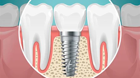 Los precios de los implantes dentales podrían sorprenderlo