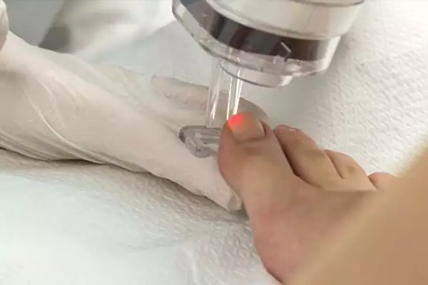 Μάθε πώς φεύγουν οι μύκητες από τα νύχια