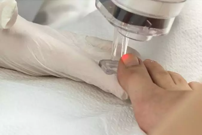 Μάθε πώς φεύγουν οι μύκητες από τα νύχια Μάθε πώς φεύγουν οι μύκητες από τα νύχια