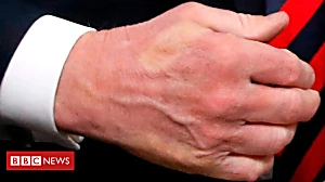 Trump's hands are back in the news