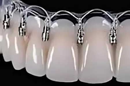 Τι είναι τα οδοντικά εμφυτεύματα χωρίς βίδες και πώς λειτουργούν Τι είναι τα οδοντικά εμφυτεύματα χωρίς βίδες και πώς λειτουργούν