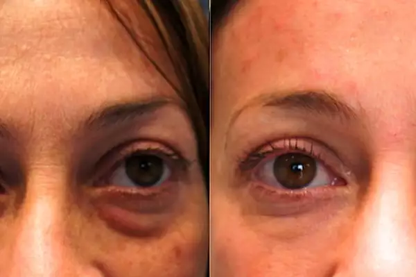 Pessoas com bolsa nos olhos devem ler isto Pessoas com bolsa nos olhos devem ler isto