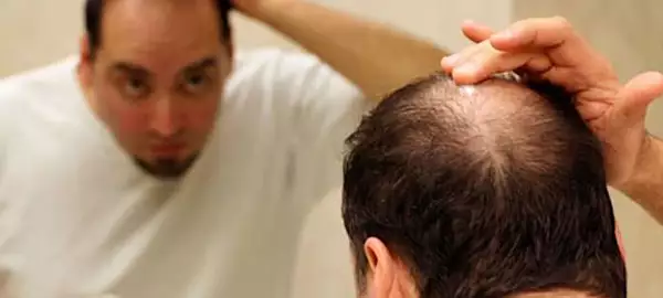 Calvície tem cura? Essa nova descoberta pode ter a resposta ideal.
