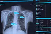 Doctors in China Are Using AI to Screen COVID-19 Patients