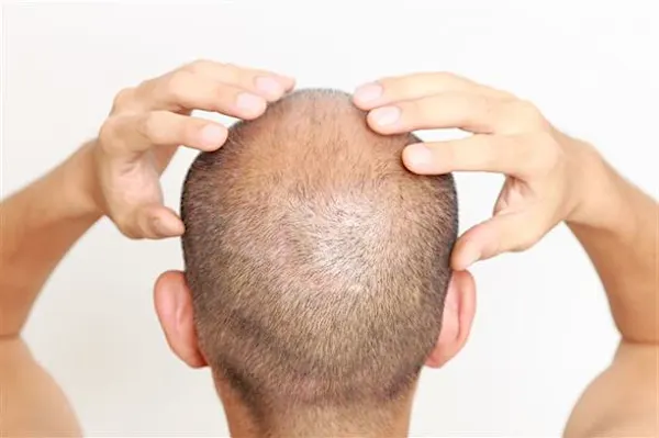 Karachi: Hair Transplant Surgery Can Be Cheaper Than You Think