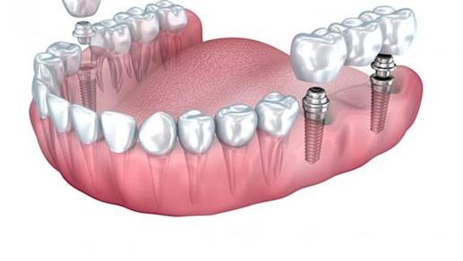 Here's What New Dental Implants Should Cost in 2021
