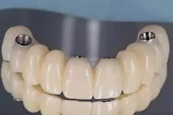 Τι καλύπτει ο ΕΟΠΥΥ για εμφυτεύματα δοντιών στην Ελλάδα Τι καλύπτει ο ΕΟΠΥΥ για εμφυτεύματα δοντιών στην Ελλάδα