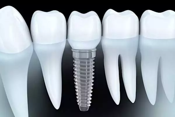 This is What Full Mouth Dental Implants Should Cost You in Nigeria!