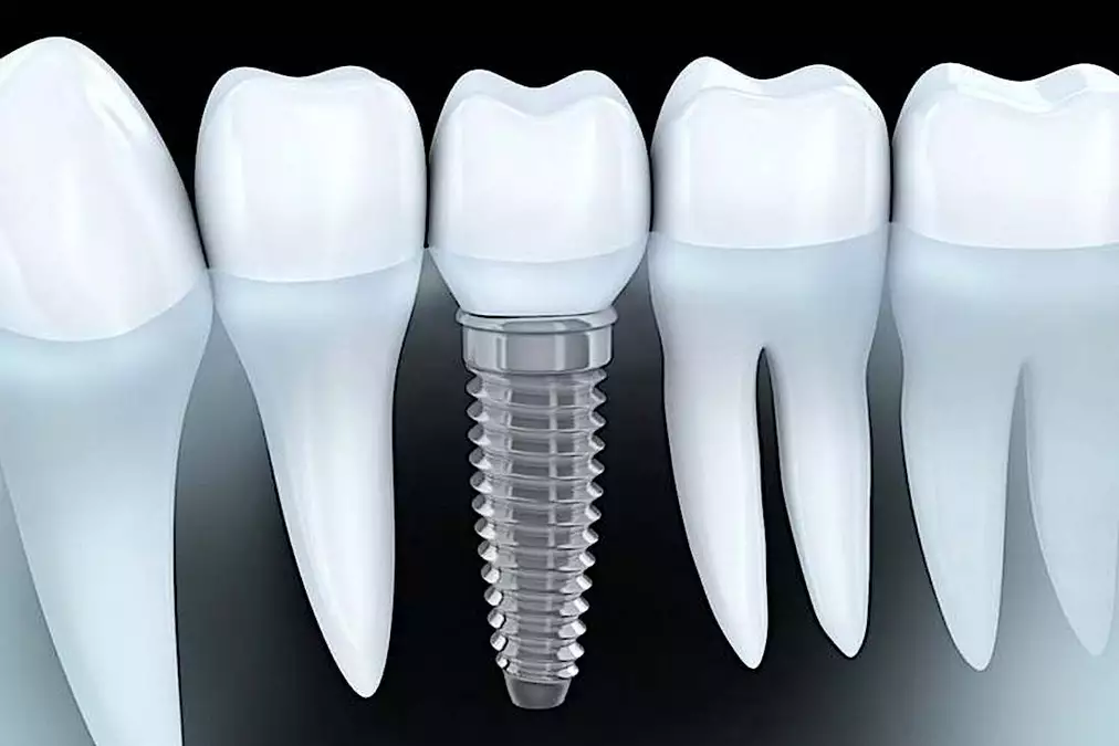 This is What Full Mouth Dental Implants Should Cost You in Greece!