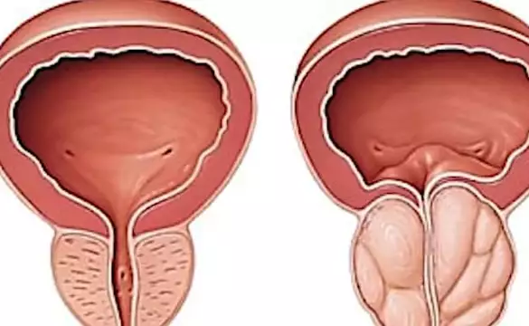 Enlarged Prostate Has Nothing To Do With Age: Just Stop Doing This One Common Thing